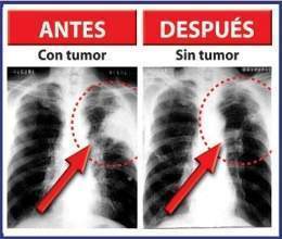 Cancer-pulmon-8.jpg