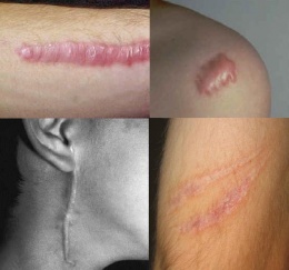Cicatrices.JPG