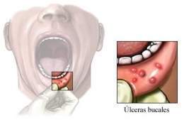 Ulceras-bucales.jpg