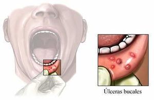 Ulceras-bucales.jpg
