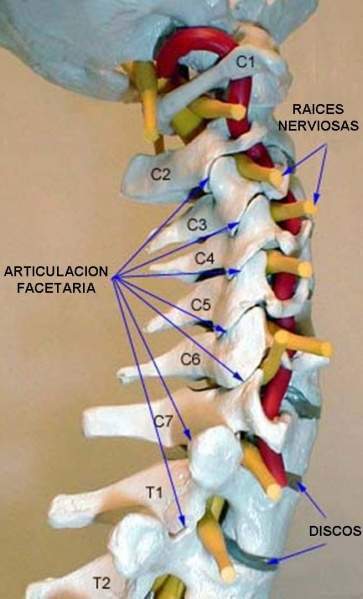 Archivo:Cervicobraquialgia.jpg