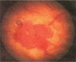 Hematuria 1.png