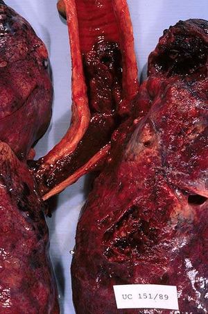 Hemorragia pulmonar 302.jpg
