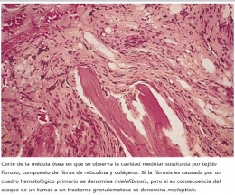 Mielofibrosis idiomática.cronica htm.JPG