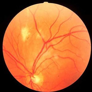 Retinitis por citomegalovirus.jpg