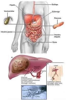 Cancer higado hepatico.jpg