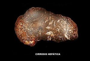 Hepatitis alcoholica1.jpg