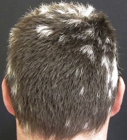 Poliosis.jpeg