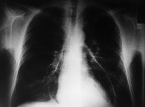 Carcin-broncog 2.jpeg