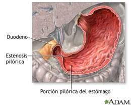 Estenosis pilórica.jpg