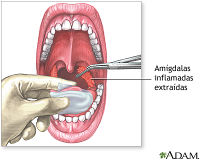 Ooforectomía laparoscópica presentando las tijeras HARMONIC ACE®+7 con  hemostasia avanzada 