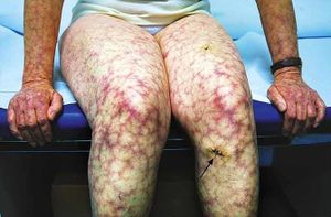 Livedo-reticularis.jpg