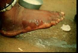 Dracunculiasis2 DPDx.jpg
