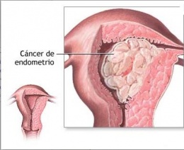 Adenocarcionoma de endometrio.JPG