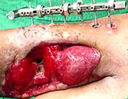 Fractura abierta1.JPG