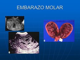Embarazo-molar-830x623.jpg