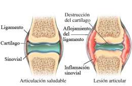 Artritis reumatoide juvenil .jpg