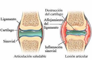 Artritis reumatoide juvenil .jpg