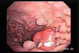 Polipoadenomatosos.jpg