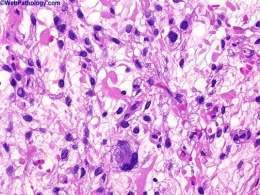 Liposarcoma.jpg