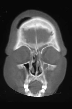 Osteomielitis del hueso frontal.jpg