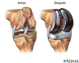 Prótesis de rodilla convencional.jpg