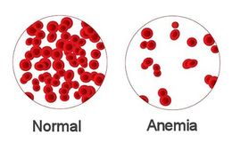 Anemia2.jpg