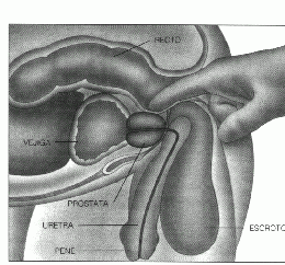 adenoma de prostata grado 2
