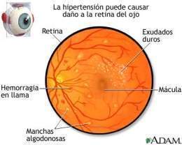 Retinopatia.jpg