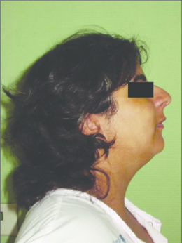 Fig-1-Vista-de-perfil-de-la-paciente-con-sindrome-de-Coffin-Siris-micrognatia.png