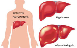 Hepatitis-autoinmune.jpg