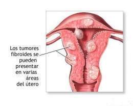 Leiomioma uterino.jpg