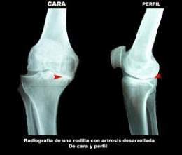Artrosis de rodilla.jpg
