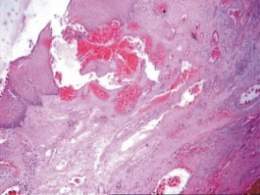 Hemangioma cavernoso f0310304.jpg