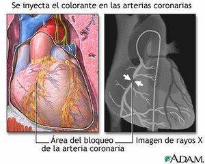 Arteripatia coronaria.jpg