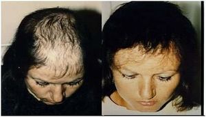 Implante de cabello.jpg