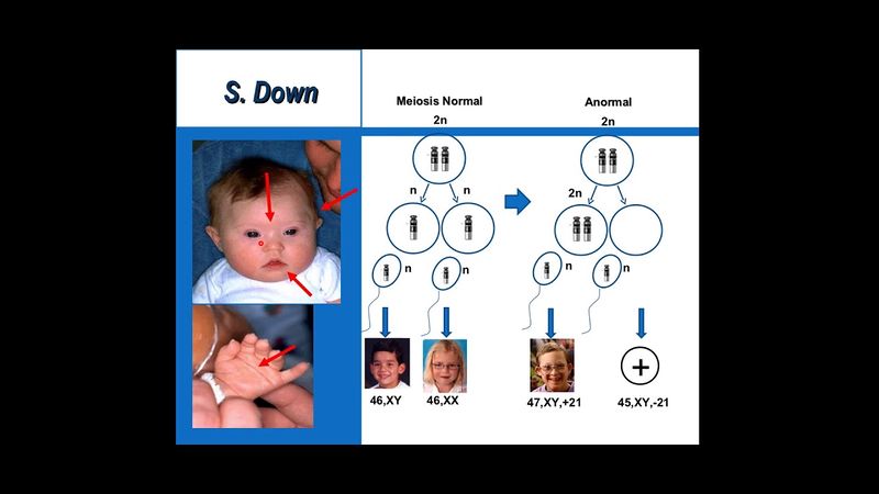 Archivo:Sindrome down.jpg