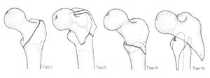 Fracturas Trocantéricas.jpg