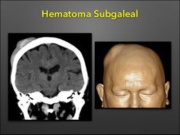 Hematoma.jpg