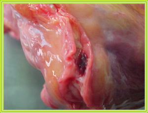 Aterosclerosis-coronaria.png