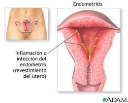 Endometritis1.jpg