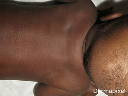 Melanosis neonatal.JPG