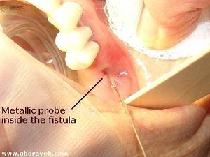 Oroantral Fistula .jpg