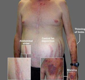 Sindrome de curchin 1.jpg
