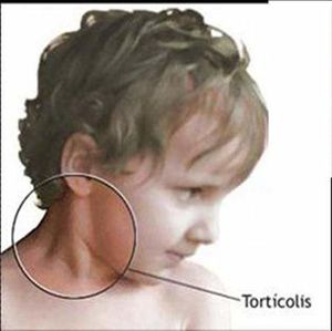Torticolis .jpg