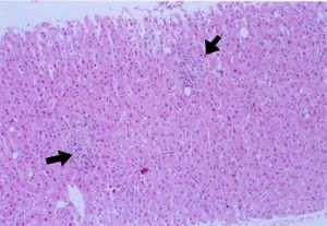 Hepatitis granulomatosa 55.jpg