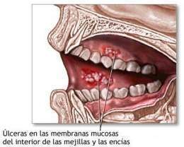 Estomatitis1.jpg