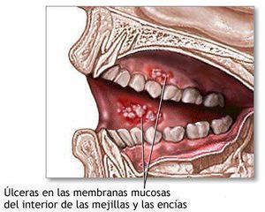 Estomatitis1.jpg