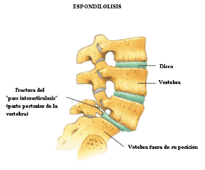 Espondilolisis2.gif