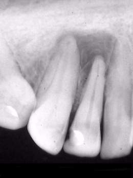 Granuloma-periapical.jpg